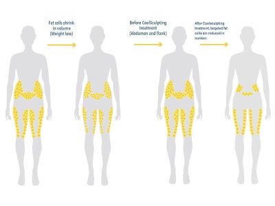 Does CoolSculpting change your body shape-min