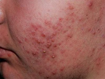 acne close up-min