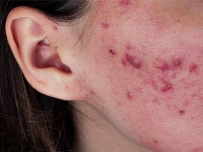 acne close up side-min