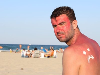 man with sun damage-min